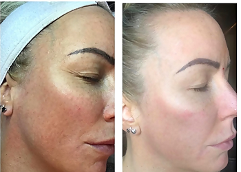 Milwaukee Med Spa Bare Beauty Medspa & Skincare