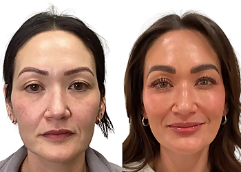 Bare Radiance Aesthetics - Thornton, CO Med Spas - Before and After Image