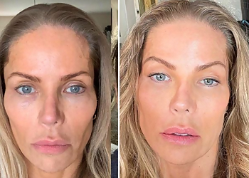 Frisco Med Spa Beverly Hills Rejuvenation Center Frisco