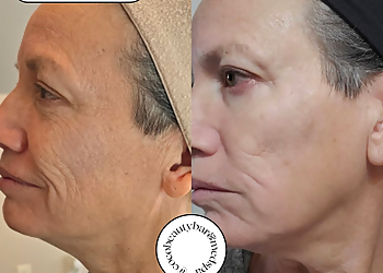 Coco Beauty Bar & Medical Spa - Baton Rouge, LA Med Spas - Before and After Image