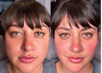 Good To Glow Med Spa and Wellness - Baltimore, MD Med Spas - Before and After Image