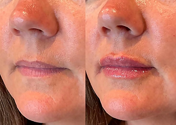 Allentown Med Spa Meesha Aesthetics