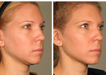 Port St Lucie Med Spa New Radiance Cosmetic Centers