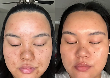 Radiant Med Spa - Fremont, CA Med Spas - Before and After Image