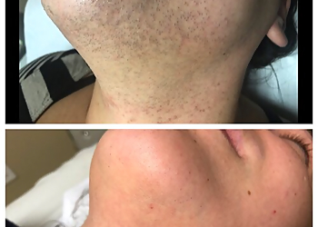 Yonkers Med Spa Simply Skin Laser Medispa