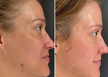 The Face Place - Baton Rouge, LA Med Spas - Before and After Image