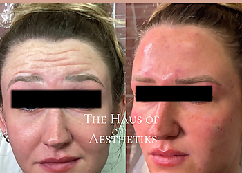 The Haus of Aesthetiks Medspa & Wellness - Grand Prairie, TX Med Spas - Treatment Image