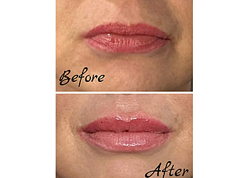 UBEST Medical Aesthetics - Akron, OH Med Spas - Before and After Image