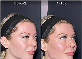 Vanity Skin Bar - Baltimore, MD Med Spas - Before and After Image